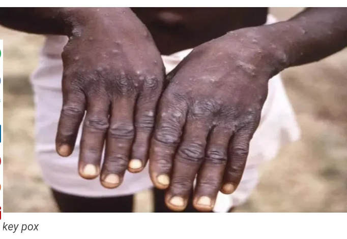 Ƙyandar biri ta ɓulla a Jihar Gombe Ƙyandar biri ta ɓulla a Jihar Gombe