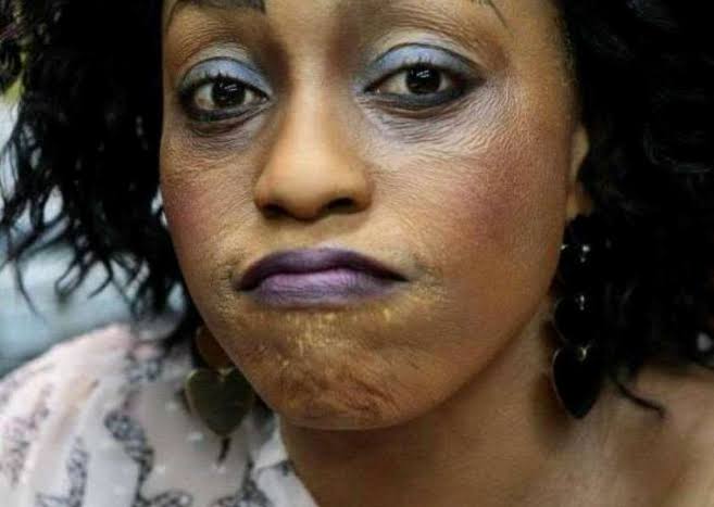 Amfani da man ‘bleaching’ na haifar da lahani ga jiki — NAFDAC Amfani da man ‘bleaching’ na haifar da lahani ga jiki — NAFDAC